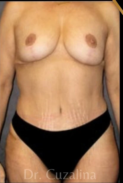 After: Breast Lift w/out Implants, Full Tummy Tuck — front · by Angelo Cuzalina, MD, DDS