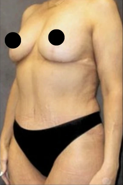 After: Breast Lift w/out Implants, Full Tummy Tuck — oblique · by Angelo Cuzalina, MD, DDS