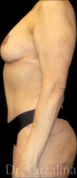 After: Breast Lift w/out Implants, Full Tummy Tuck — profile · by Angelo Cuzalina, MD, DDS