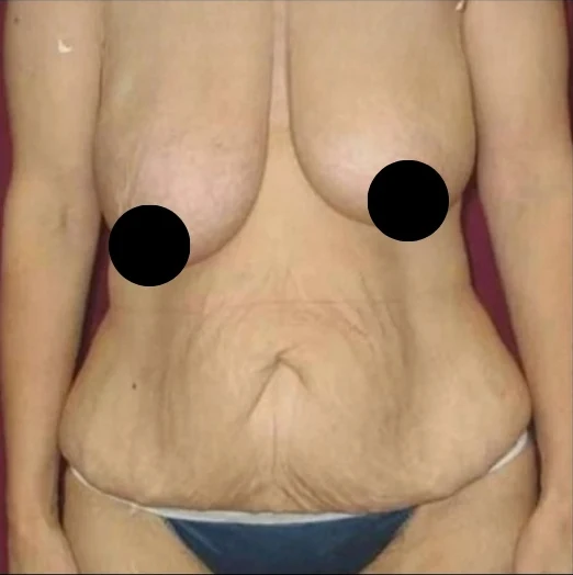 Before: Breast Reduction & Lift, Tummy Tuck, Lipo360 · by Angelo Cuzalina, MD, DDS