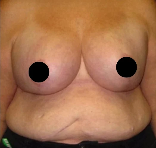 After: Breast Reduction & Lift · by Angelo Cuzalina, MD, DDS