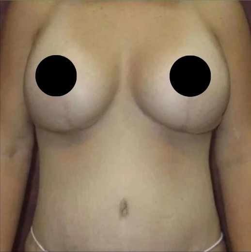 After: Breast Reduction & Aug/Lift, Tummy Tuck, Lipo360 · by Angelo Cuzalina, MD, DDS