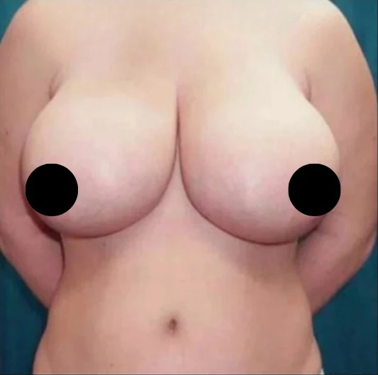 Before: Breast Reduction & Lift · by Angelo Cuzalina, MD, DDS