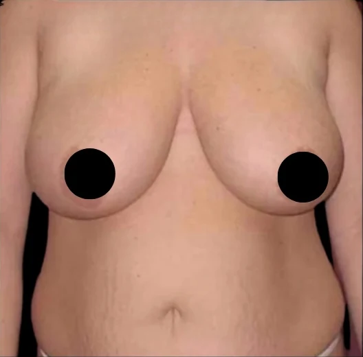 Before: Breast Reduction & Lift · by Angelo Cuzalina, MD, DDS