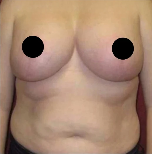 After: Breast Reduction & Lift · by Angelo Cuzalina, MD, DDS