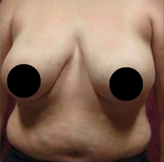 Before: Breast Reduction & Lift · by Angelo Cuzalina, MD, DDS