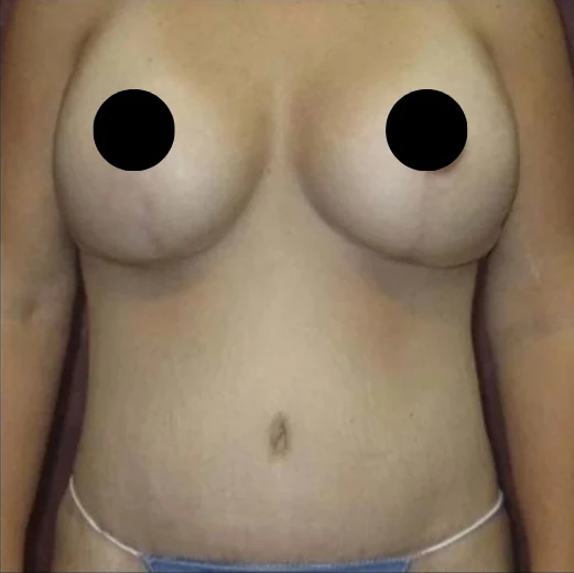After: Breast Reduction & Aug/Lift · by Angelo Cuzalina, MD, DDS