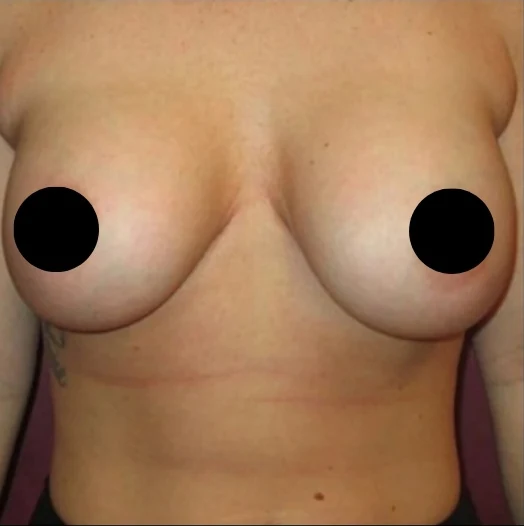 Before: Breast Reduction & Lift · by Angelo Cuzalina, MD, DDS