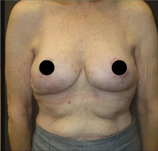 After: Breast Reduction & Lift · by Angelo Cuzalina, MD, DDS