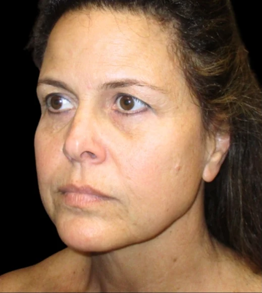 Before: Endoscopic Forehead & Brow Lift — three-quarter · by Angelo Cuzalina, MD, DDS