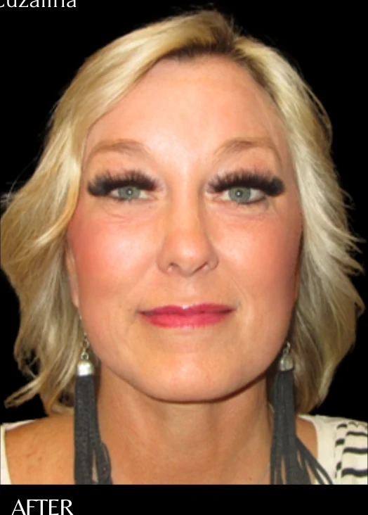 After: Full Lower Face & Neck Lift, Endoscopic Forehead & Brow Lift, CO2 Laser Resurfacing — front · by Angelo Cuzalina, MD, DDS