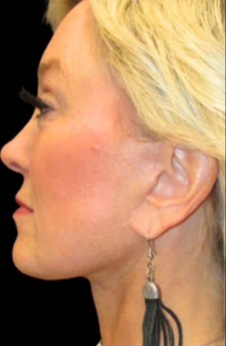 After: Full Lower Face & Neck Lift, Endoscopic Forehead & Brow Lift, CO2 Laser Resurfacing — profile · by Angelo Cuzalina, MD, DDS
