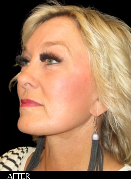 After: Full Lower Face & Neck Lift, Endoscopic Forehead & Brow Lift, CO2 Laser Resurfacing — three-quarter · by Angelo Cuzalina, MD, DDS