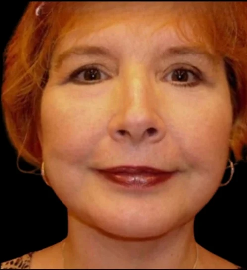 After: Blepharoplasty, Chin Augmentation, Deep Plane Lower Face Lift · by Angelo Cuzalina, MD, DDS