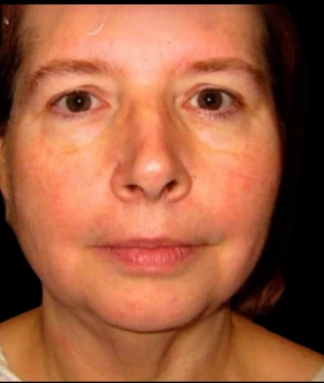 Before: Blepharoplasty, Chin Augmentation, Deep Plane Lower Face Lift · by Angelo Cuzalina, MD, DDS