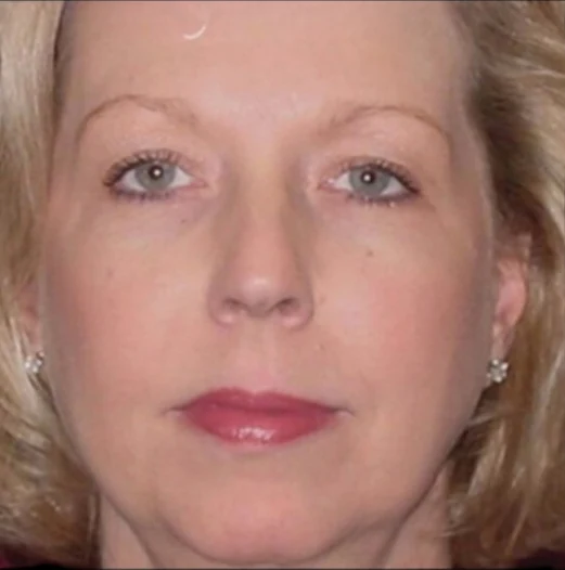 Before: Chin Augmentation, Deep Plane Lower Face Lift — front · by Angelo Cuzalina, MD, DDS