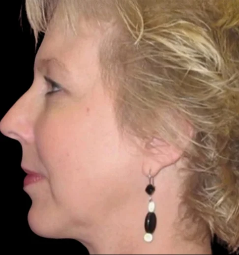 After: Chin Augmentation, Deep Plane Lower Face Lift — profile · by Angelo Cuzalina, MD, DDS