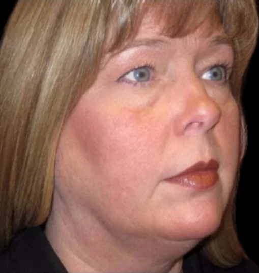 Before: Blepharoplasty, Brow Lift, Lower Face & Neck Lift · by Angelo Cuzalina, MD, DDS