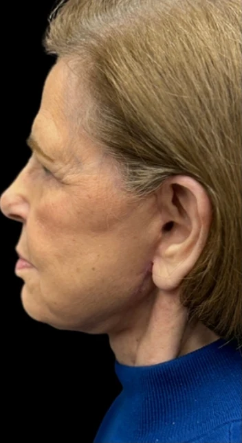 After: Lower Face & Neck Lift · by Angelo Cuzalina, MD, DDS