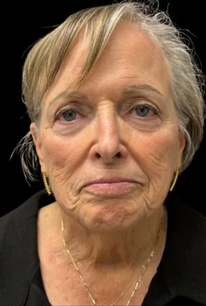 Before: Lower Face & Neck Lift, Chin Implant — front · by Angelo Cuzalina, MD, DDS