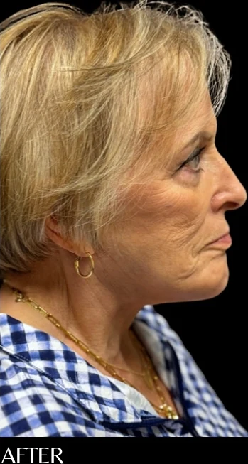 After: Lower Face & Neck Lift, Chin Implant — profile · by Angelo Cuzalina, MD, DDS