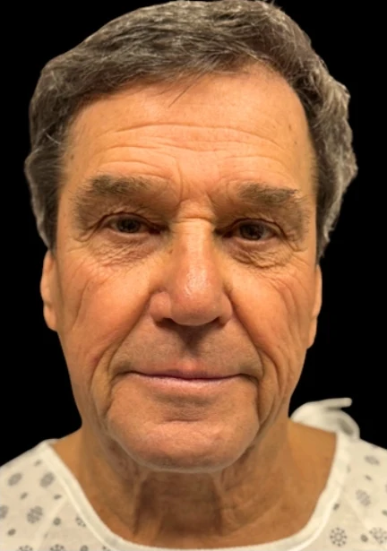Before: Lower Face & Neck Lift — front · by Angelo Cuzalina, MD, DDS