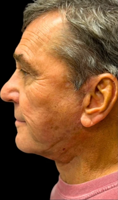 After: Lower Face & Neck Lift — profile · by Angelo Cuzalina, MD, DDS