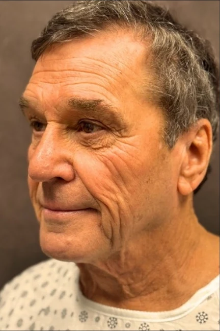 Before: Lower Face & Neck Lift — three-quarter · by Angelo Cuzalina, MD, DDS