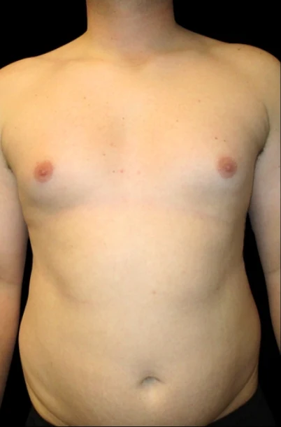 Before: Lipo to Chest, Excision of Tissue with Vaser — front · by Angelo Cuzalina, MD, DDS