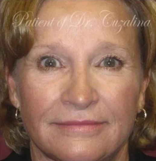 After: Blepharoplasty, Laser Skin Resurfacing, Brow Lift · by Angelo Cuzalina, MD, DDS