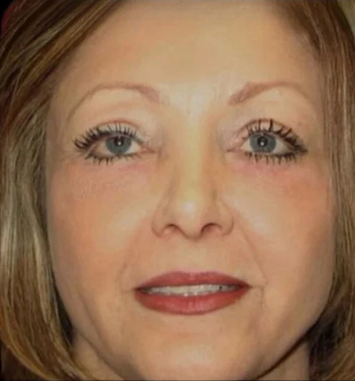 After: Blepharoplasty, Laser Skin Resurfacing · by Angelo Cuzalina, MD, DDS