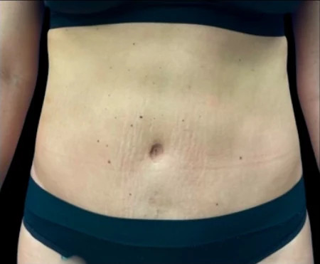 Before: Hidef Lipo · by Pasquale Tolomeo, MD