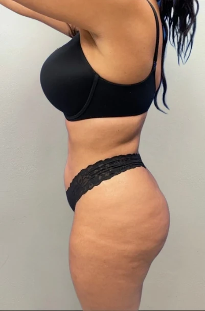 Before: Hidef Lipo & Thigh Lipo w/ Vaser Renuvion — profile · by Pasquale Tolomeo, MD