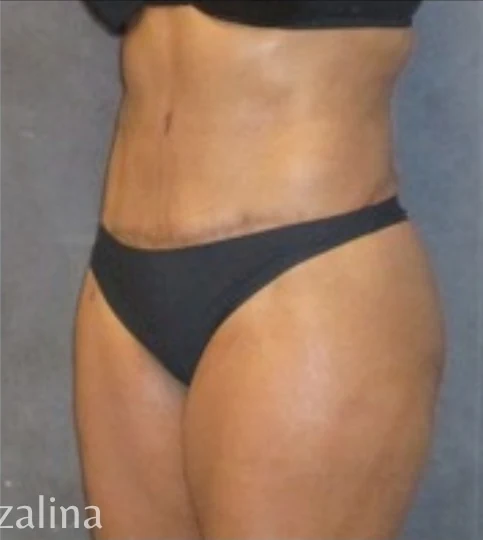 After: Tummy Tuck & Lipo to Waist & Hips — oblique · by Angelo Cuzalina, MD, DDS