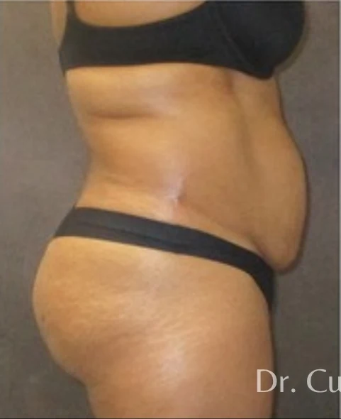 Before: Tummy Tuck & Lipo to Waist & Hips — profile · by Angelo Cuzalina, MD, DDS