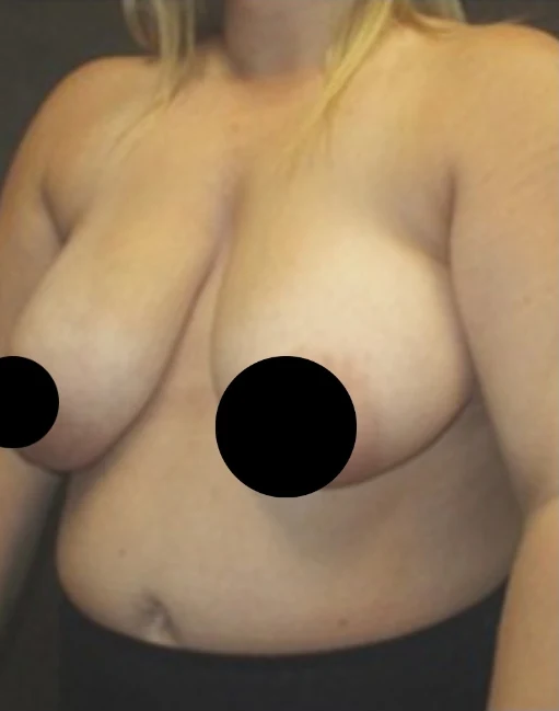 Before: Breast & Lift · by Angelo Cuzalina, MD, DDS