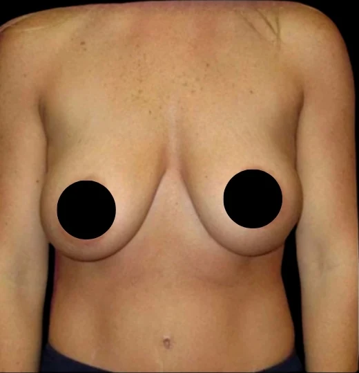 Before: Breast Augmentation, Lift, & Revision · by Angelo Cuzalina, MD, DDS