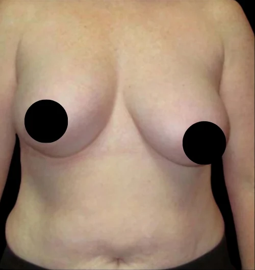 Before: Breast Augmentation, Lift, & Revision · by Angelo Cuzalina, MD, DDS