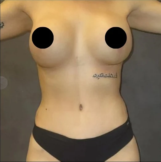 After: Breast Augmentation, Lift, & Revision · by Angelo Cuzalina, MD, DDS