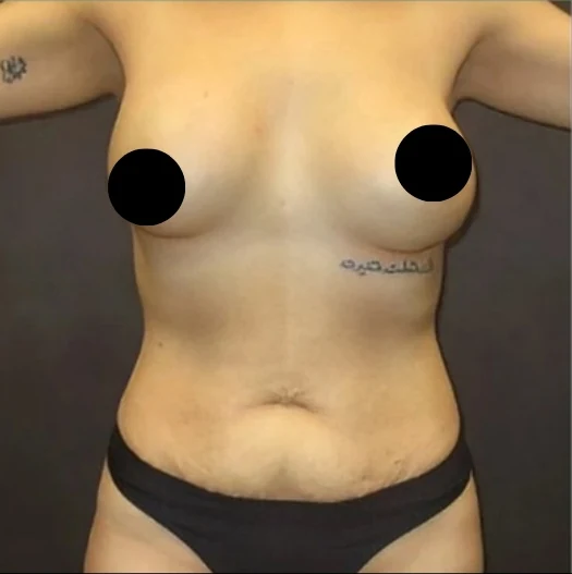Before: Breast Augmentation, Lift, & Revision · by Angelo Cuzalina, MD, DDS