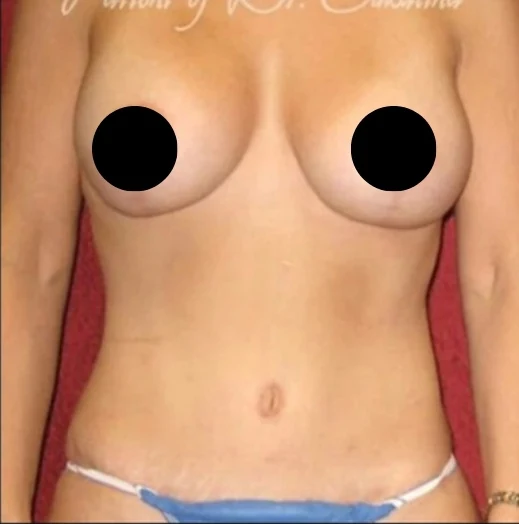 After: Breast Aug/Lift, Tummy Tuck, Lipo360 · by Angelo Cuzalina, MD, DDS