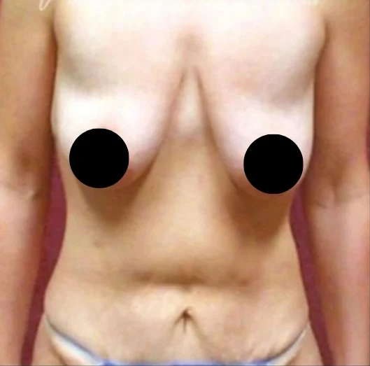 Before: Breast Aug/Lift, Tummy Tuck, Lipo360 · by Angelo Cuzalina, MD, DDS