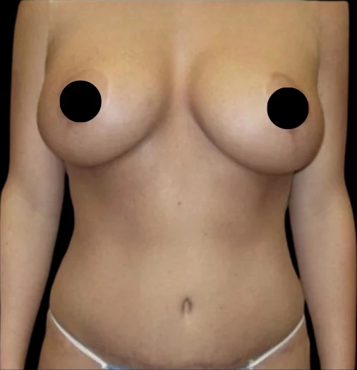 After: Breast Aug/Lift, Tummy Tuck, Lipo360 · by Angelo Cuzalina, MD, DDS