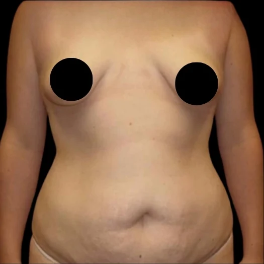 Before: Breast Aug/Lift, Tummy Tuck, Lipo360 · by Angelo Cuzalina, MD, DDS