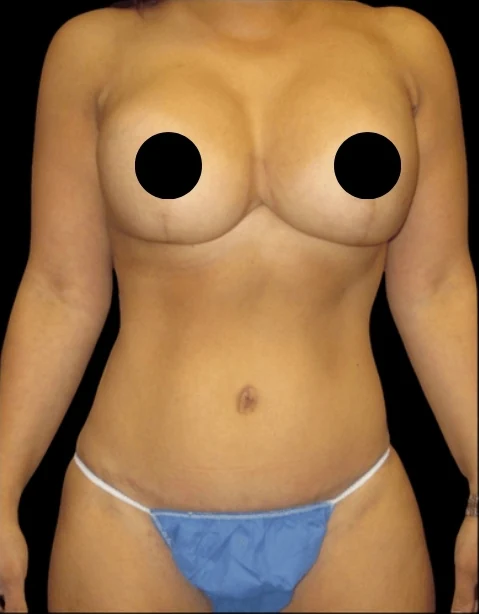 After: Breast Aug/Lift, Tummy Tuck, Lipo360 · by Angelo Cuzalina, MD, DDS