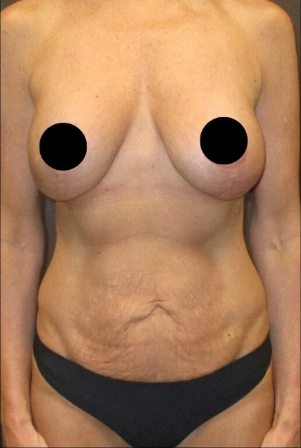 Before: Breast Aug/Lift, Tummy Tuck, Lipo360 · by Angelo Cuzalina, MD, DDS