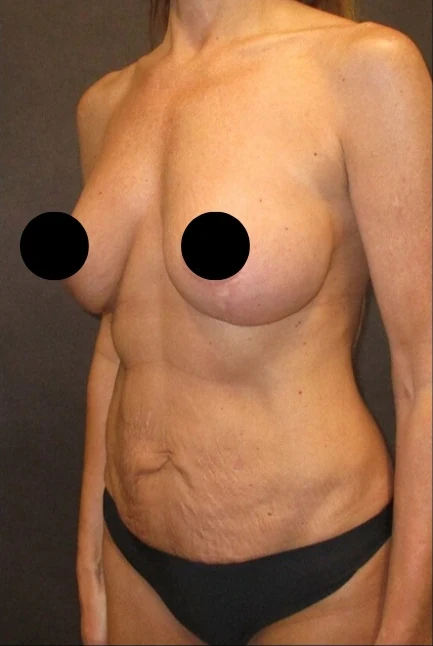 Before: Breast Aug/Lift, Tummy Tuck, Lipo360 · by Angelo Cuzalina, MD, DDS