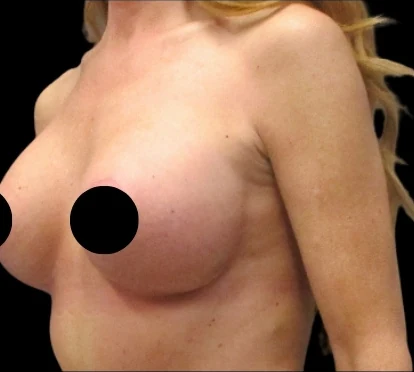 After: Breast Aug/Lift · by Angelo Cuzalina, MD, DDS