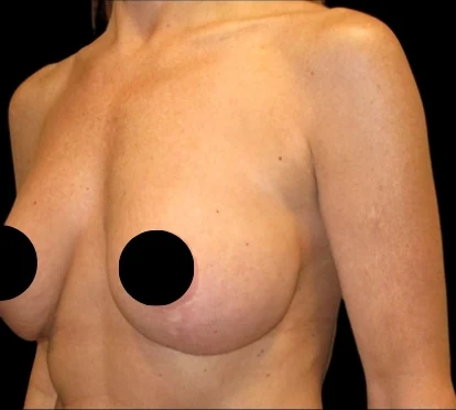 Before: Breast Aug/Lift · by Angelo Cuzalina, MD, DDS