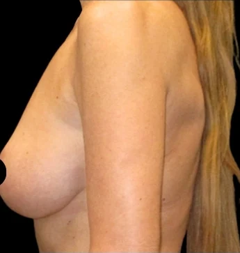 Before: Breast Aug/Lift · by Angelo Cuzalina, MD, DDS